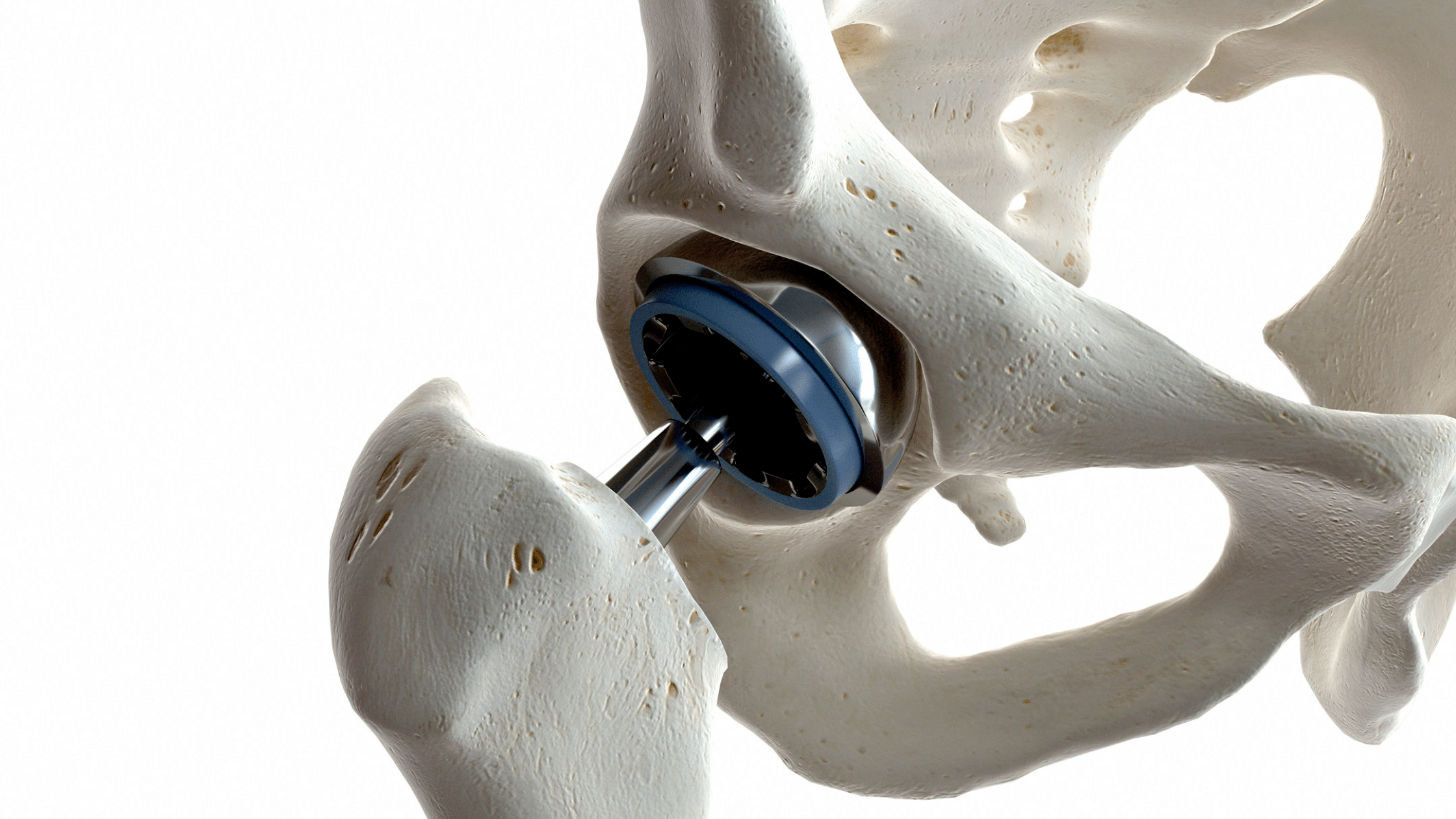 what is orthopaedics? hip replacement