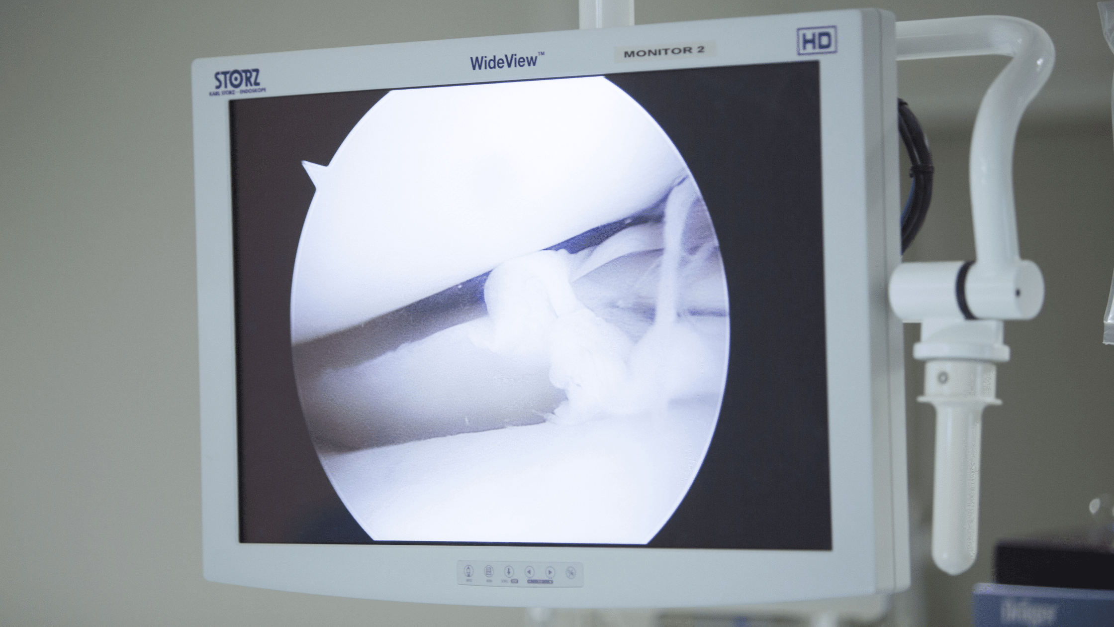 what is arthroscopy