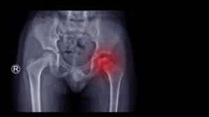 Image of a hip joint X-ray, with the joint highlighted in red