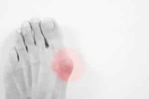 A female runner's foot, showing a highly inflamed bunion at the base of her big toe