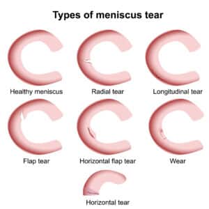 Diagram illustrating different types of meniscus tears